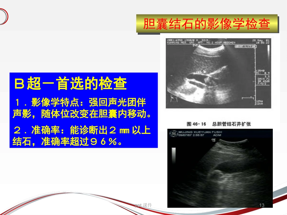 胆囊结石 ppt课件_第13页