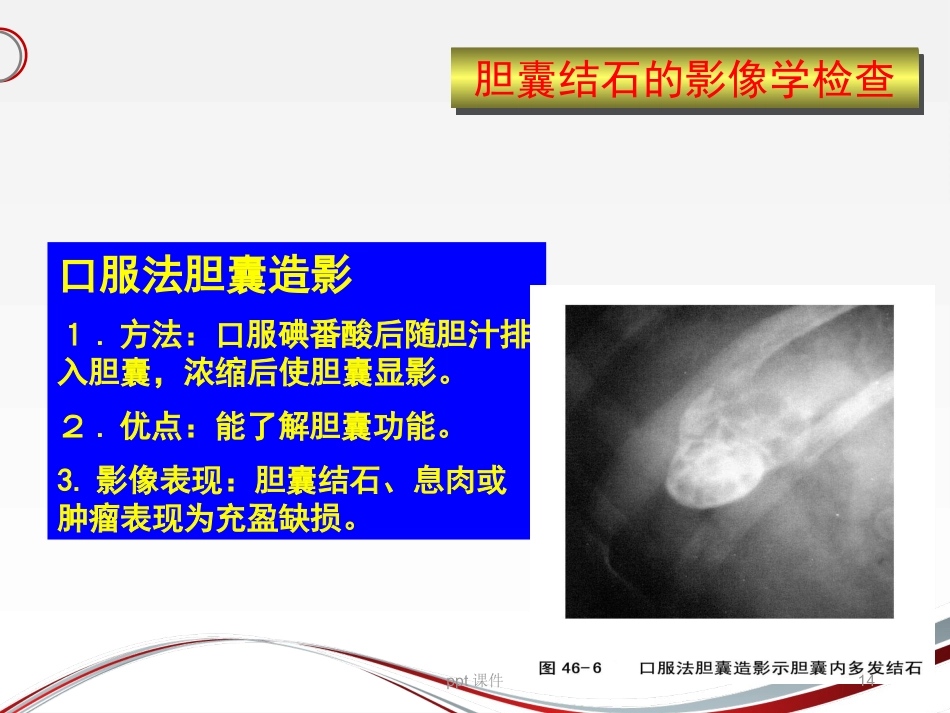 胆囊结石 ppt课件_第14页