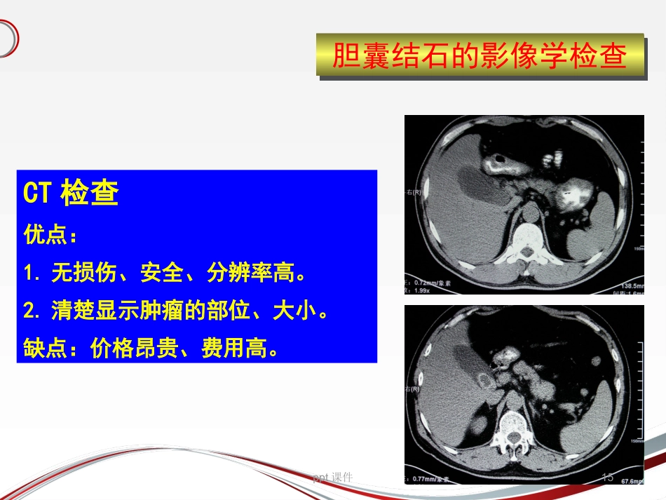 胆囊结石 ppt课件_第15页