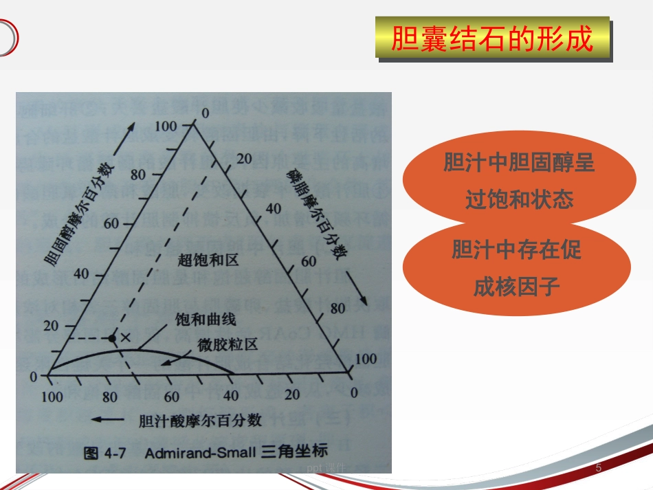 胆囊结石 ppt课件_第5页