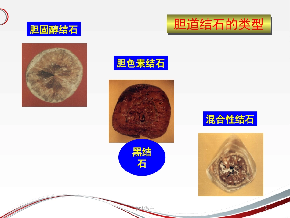 胆囊结石 ppt课件_第6页