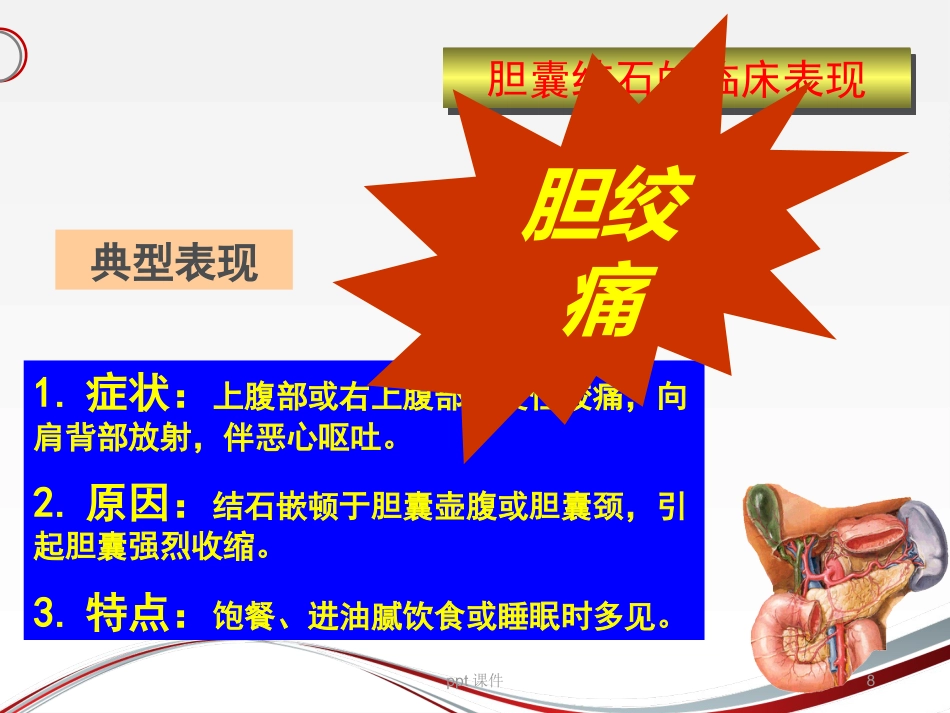 胆囊结石 ppt课件_第8页