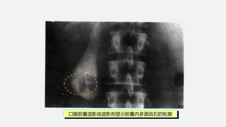 胆道疾病特殊检查ppt课件_第12页