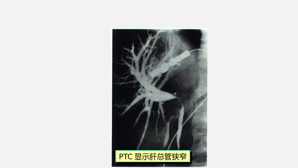 胆道疾病特殊检查ppt课件_第15页