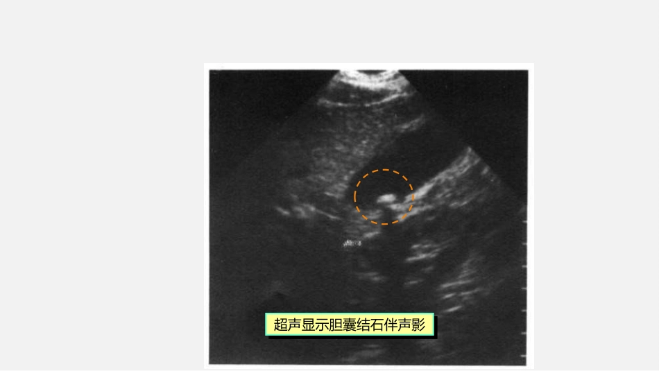 胆道疾病特殊检查ppt课件_第5页