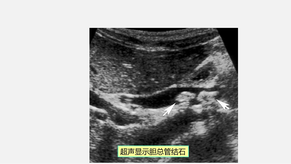 胆道疾病特殊检查ppt课件_第8页