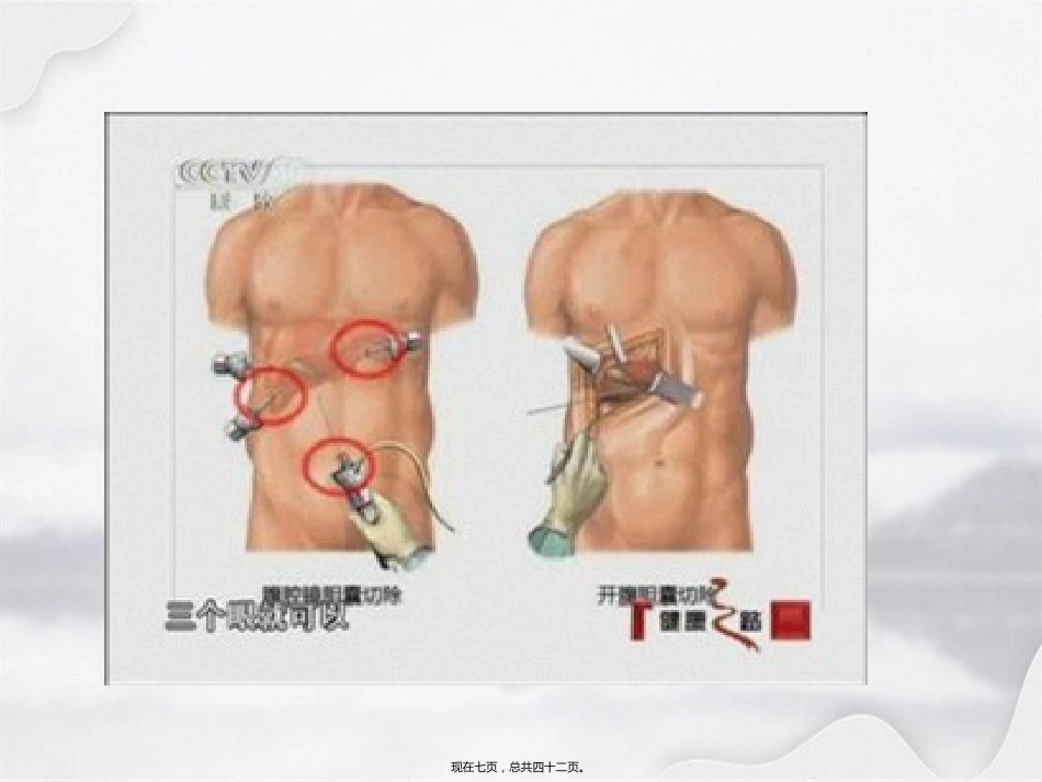 腹腔镜在肝胆胰外科应用进展_第7页