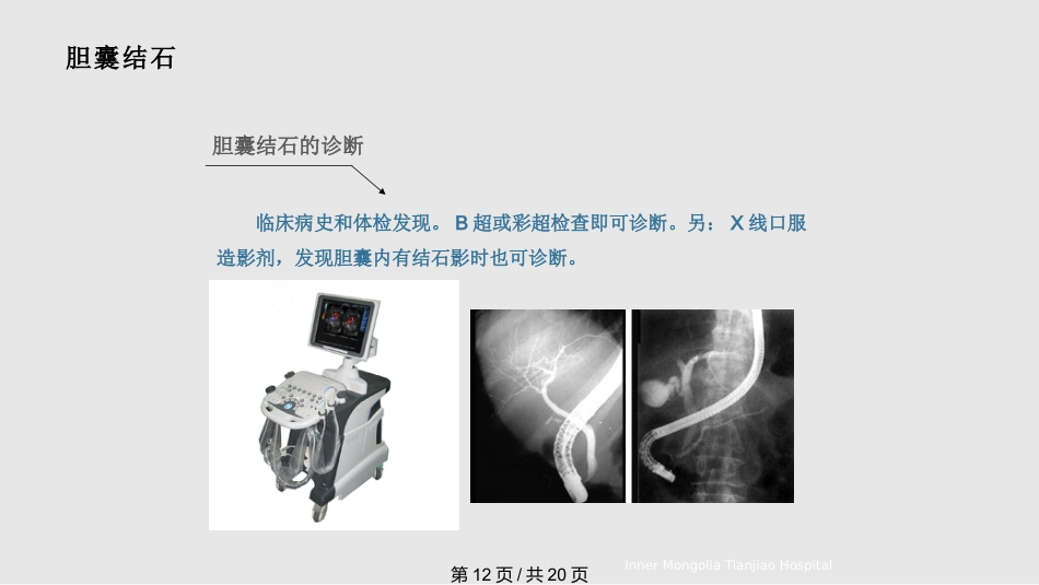 胆结石与胆囊结石PPT课件_第12页