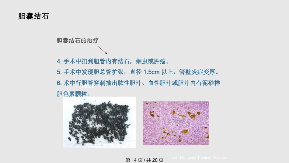 胆结石与胆囊结石PPT课件_第14页