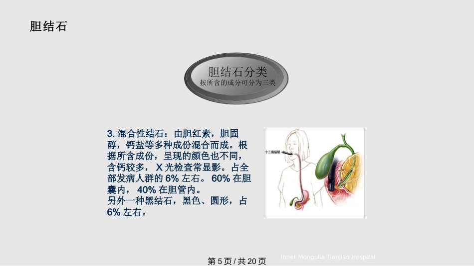 胆结石与胆囊结石PPT课件_第5页