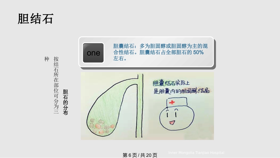 胆结石与胆囊结石PPT课件_第6页