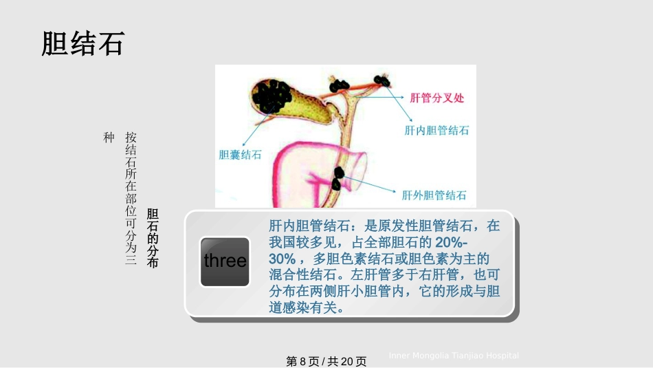 胆结石与胆囊结石PPT课件_第8页
