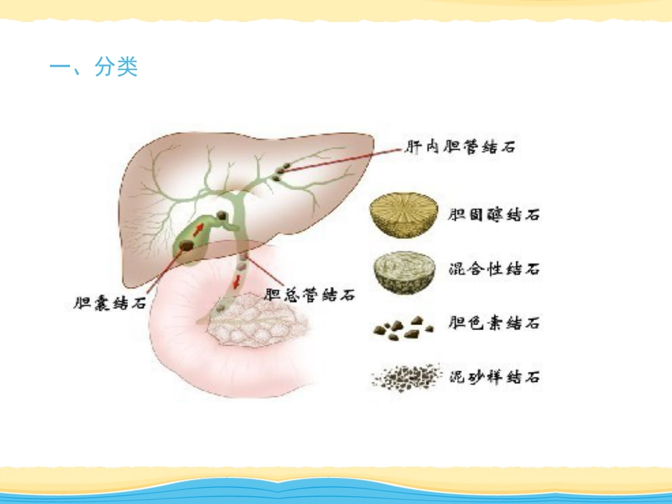 胆结石、慢性胰腺炎_第2页