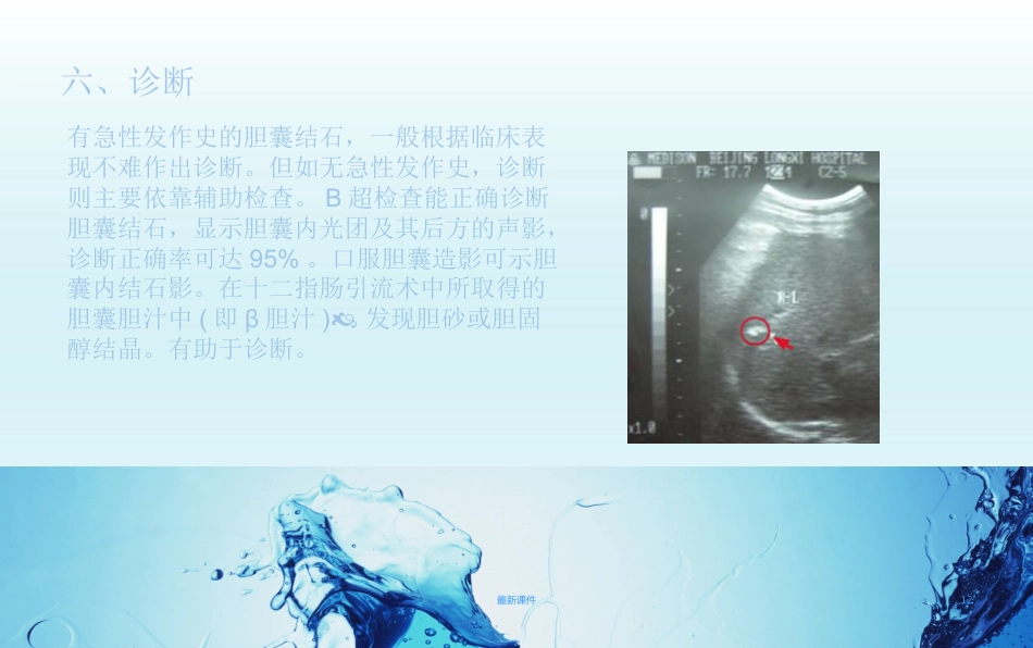 胆结石疾病教程_第12页