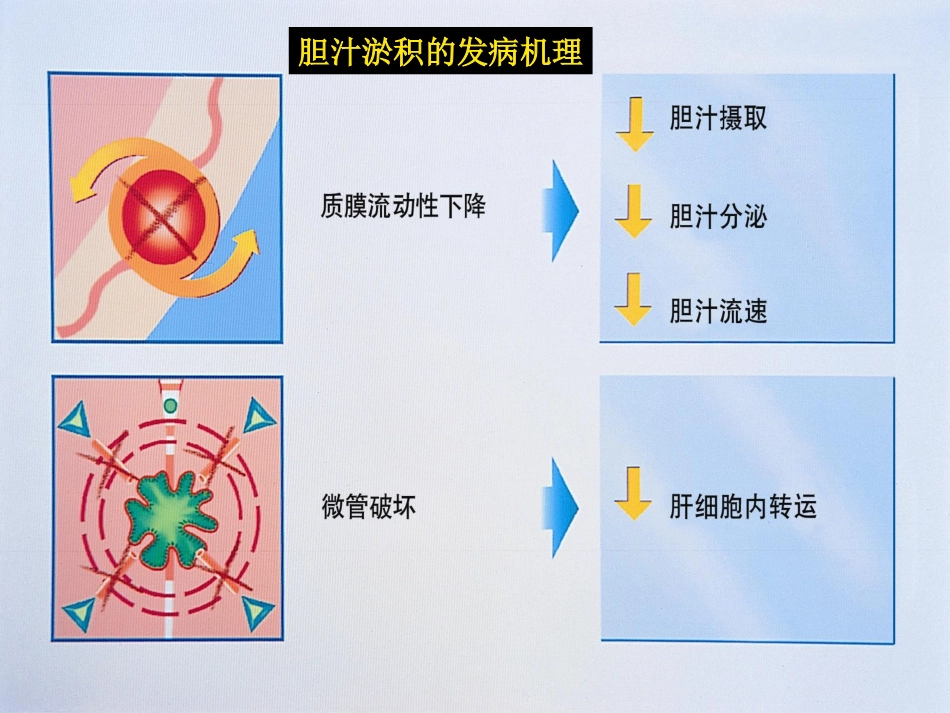 胆汁淤积性肝病介绍_第14页