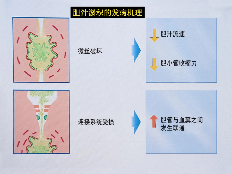 胆汁淤积性肝病介绍_第15页