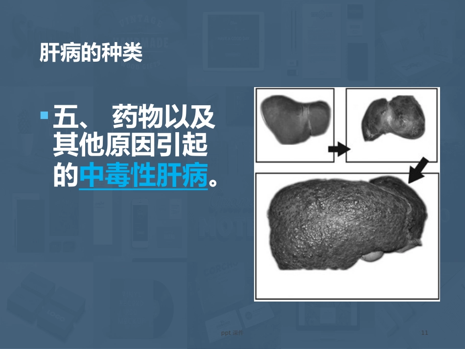 常见肝病成因与防治 ppt课件_第11页
