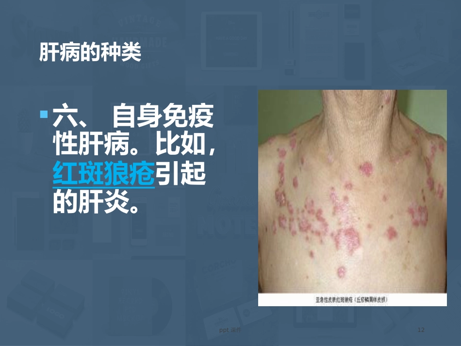 常见肝病成因与防治 ppt课件_第12页