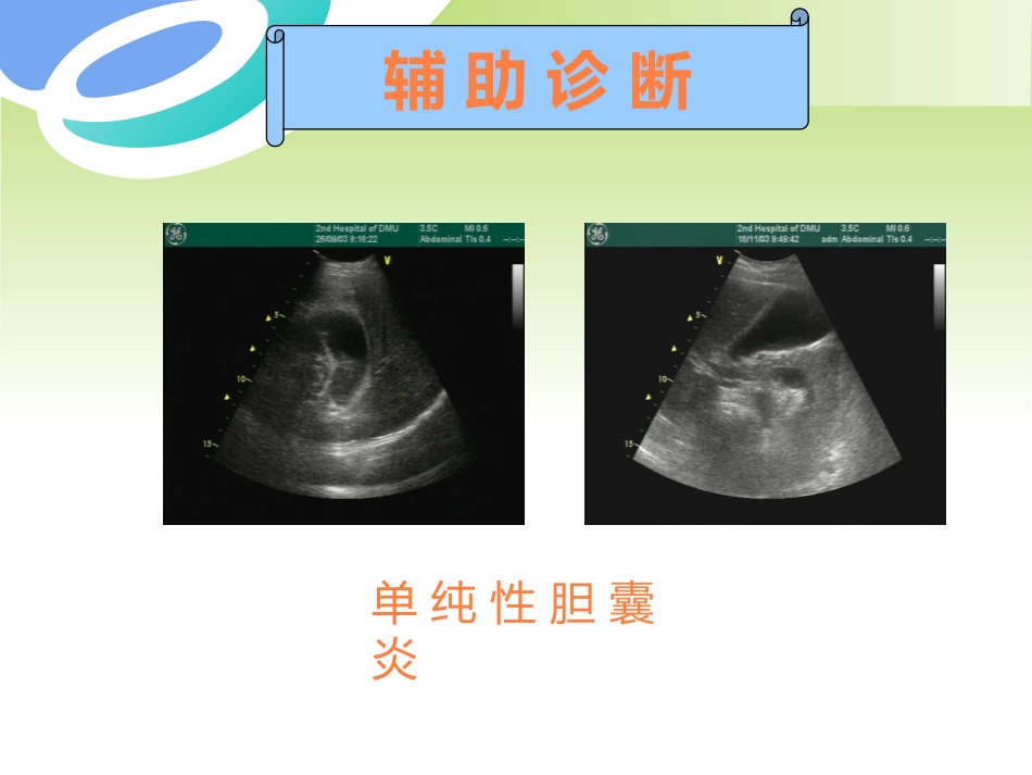 胆囊疾病及防治PPT课件_第11页