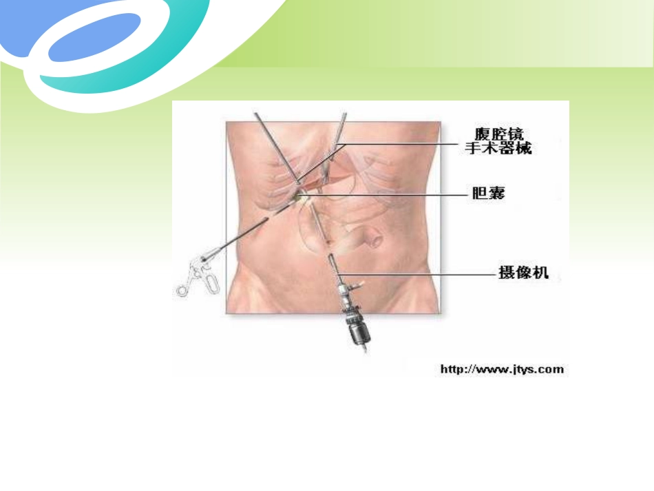 胆囊疾病及防治PPT课件_第15页