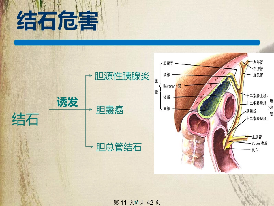 胆石症课件_第11页