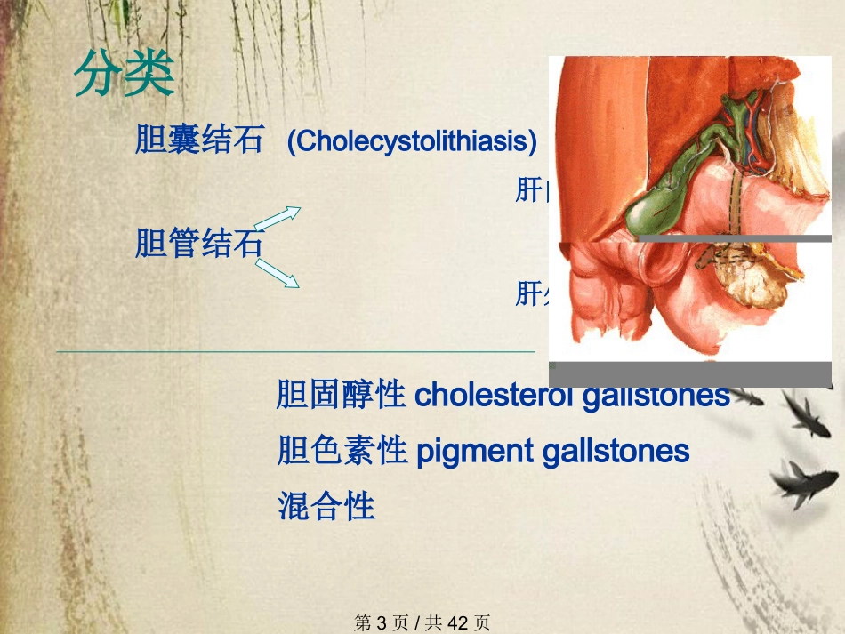 胆石症课件_第3页