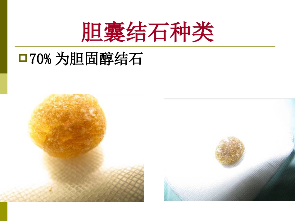 胆囊结石成因和治疗进展PPT课件_第7页