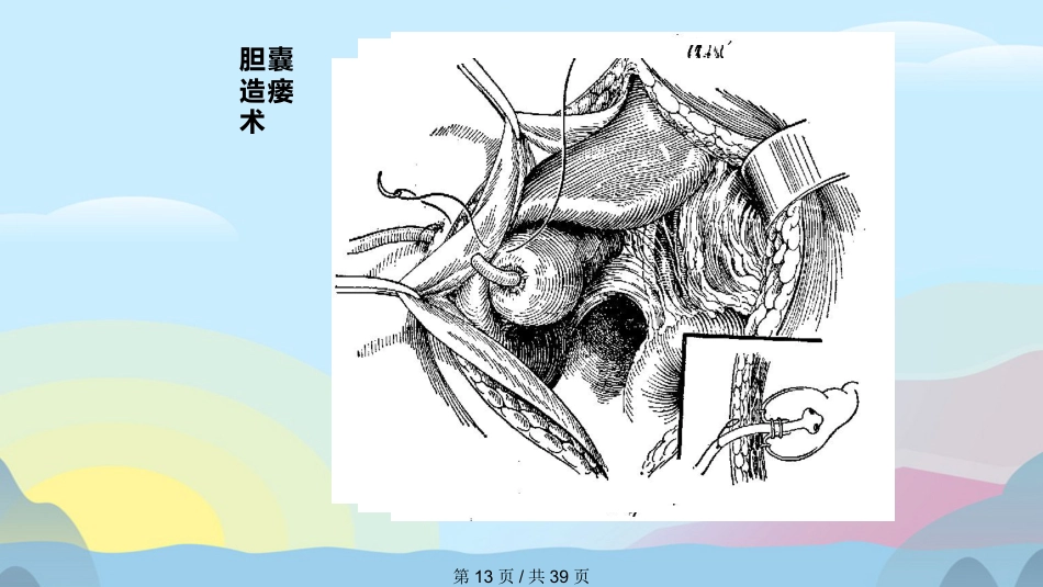 胆囊结石胆囊炎实用课件PPT_第13页