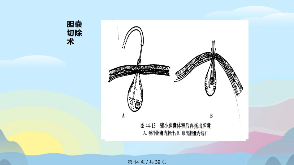 胆囊结石胆囊炎实用课件PPT_第14页