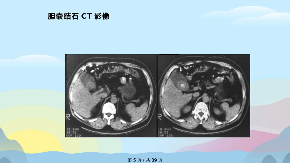 胆囊结石胆囊炎实用课件PPT_第5页