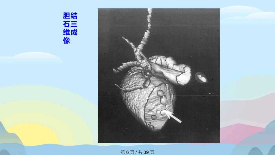 胆囊结石胆囊炎实用课件PPT_第6页