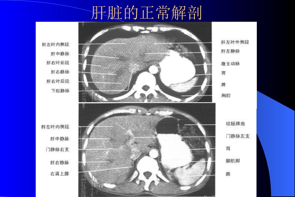 MR在肝脏病变诊断中应用_第2页