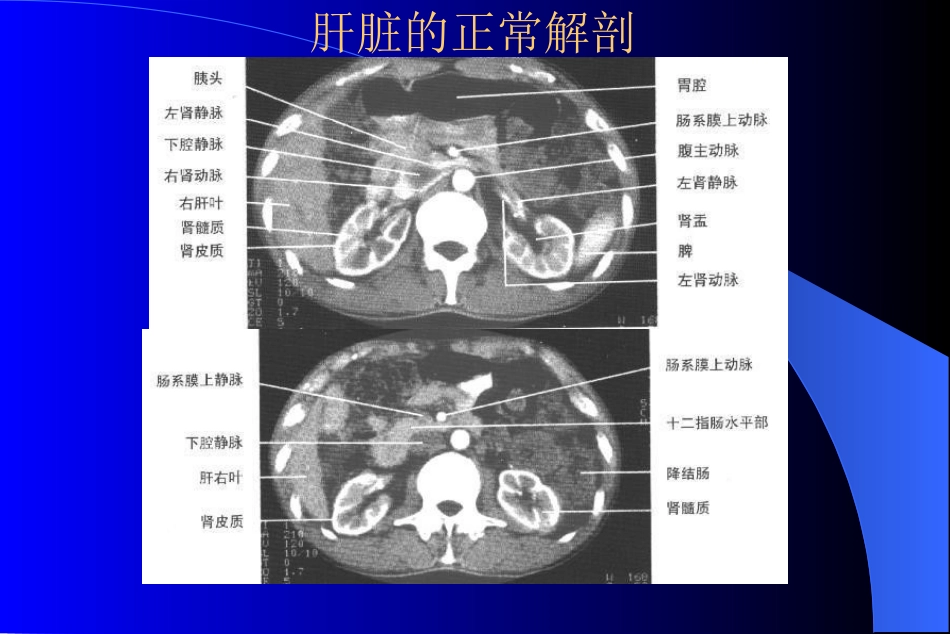 MR在肝脏病变诊断中应用_第4页