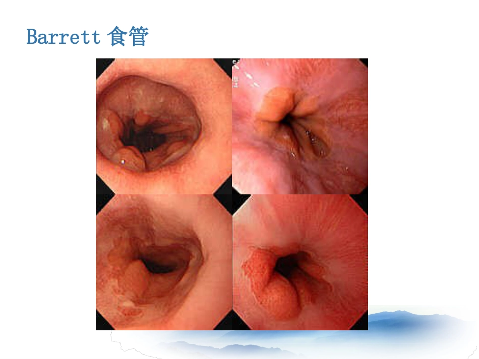 常见消化系统疾病的内镜诊断_第10页