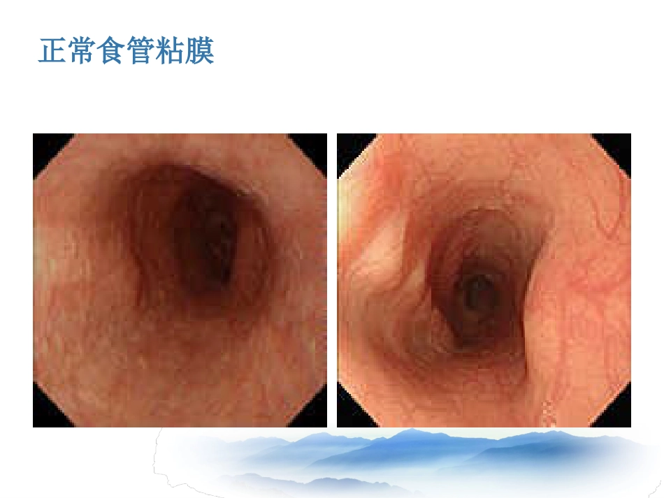 常见消化系统疾病的内镜诊断_第3页