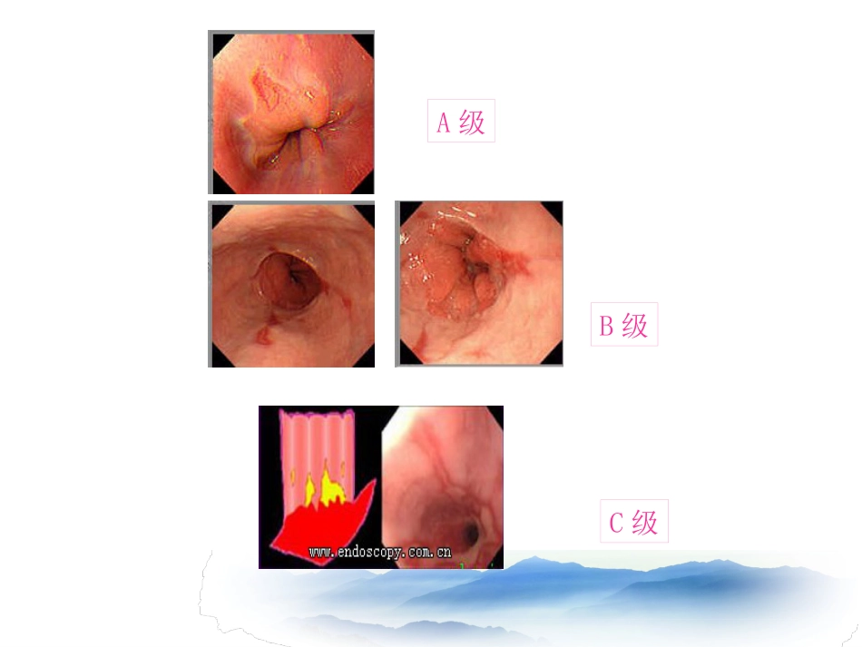常见消化系统疾病的内镜诊断_第8页
