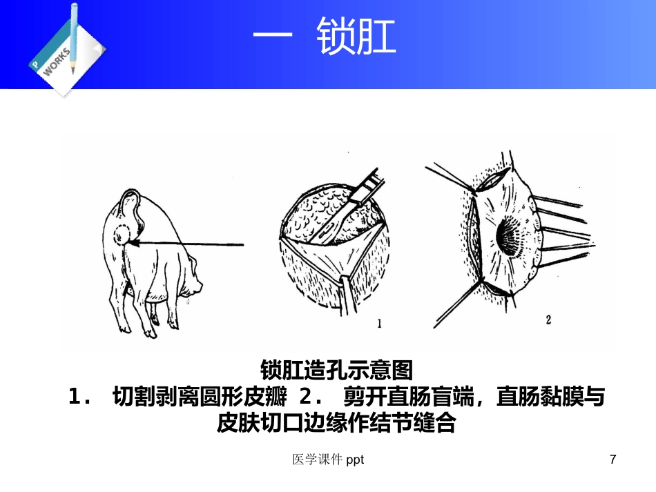 《直肠及肛门疾病》PPT课件_第7页