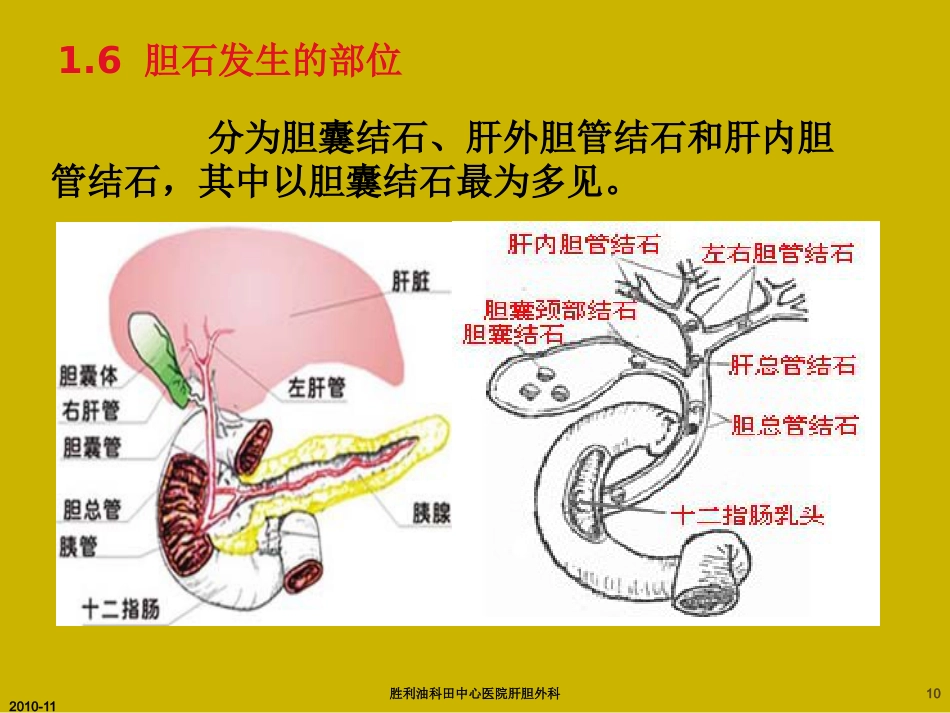 胆囊炎与胆石症ppt_第10页