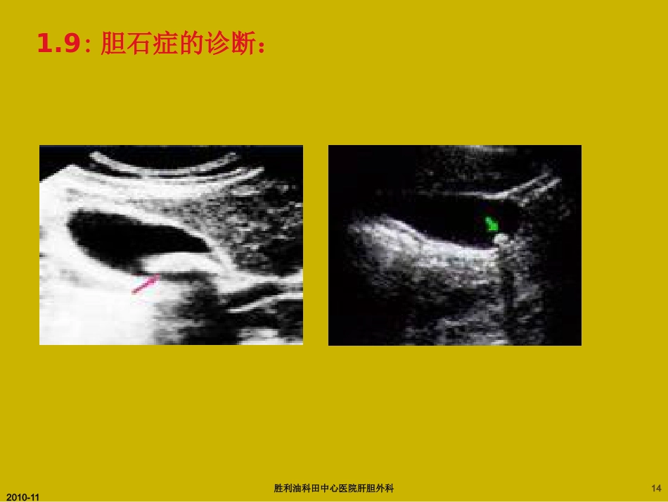 胆囊炎与胆石症ppt_第14页