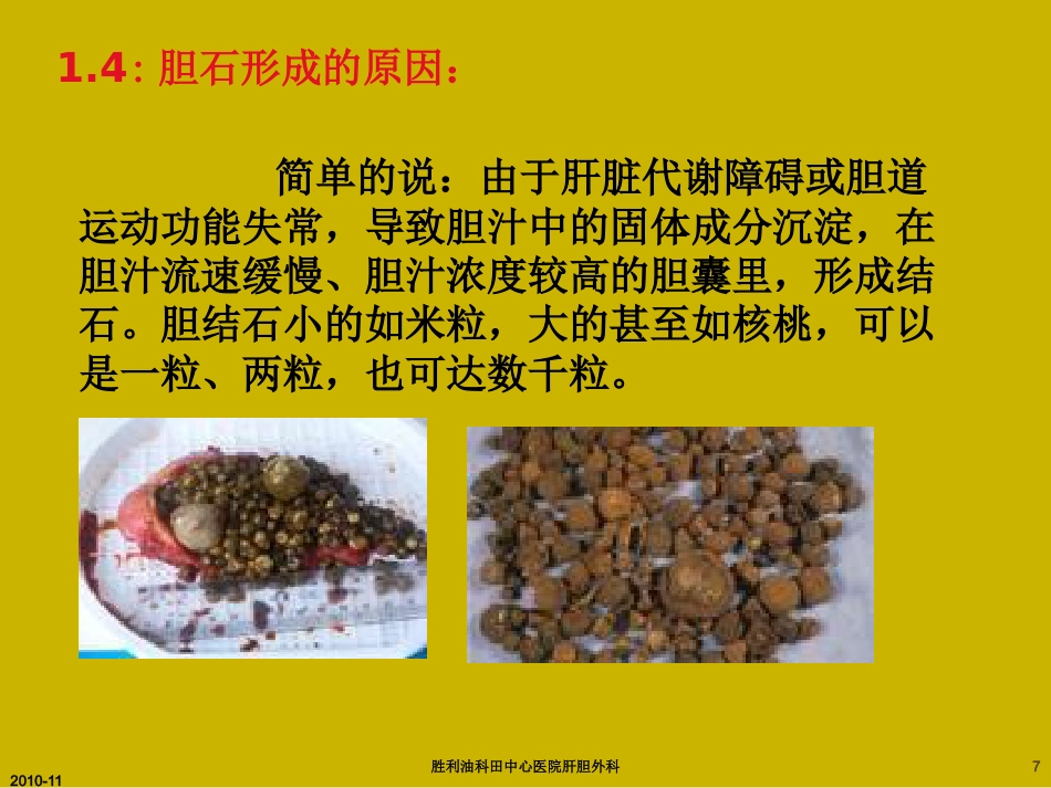 胆囊炎与胆石症ppt_第7页