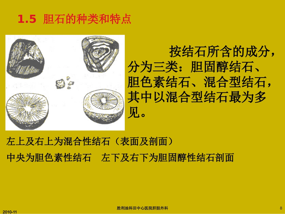胆囊炎与胆石症ppt_第8页
