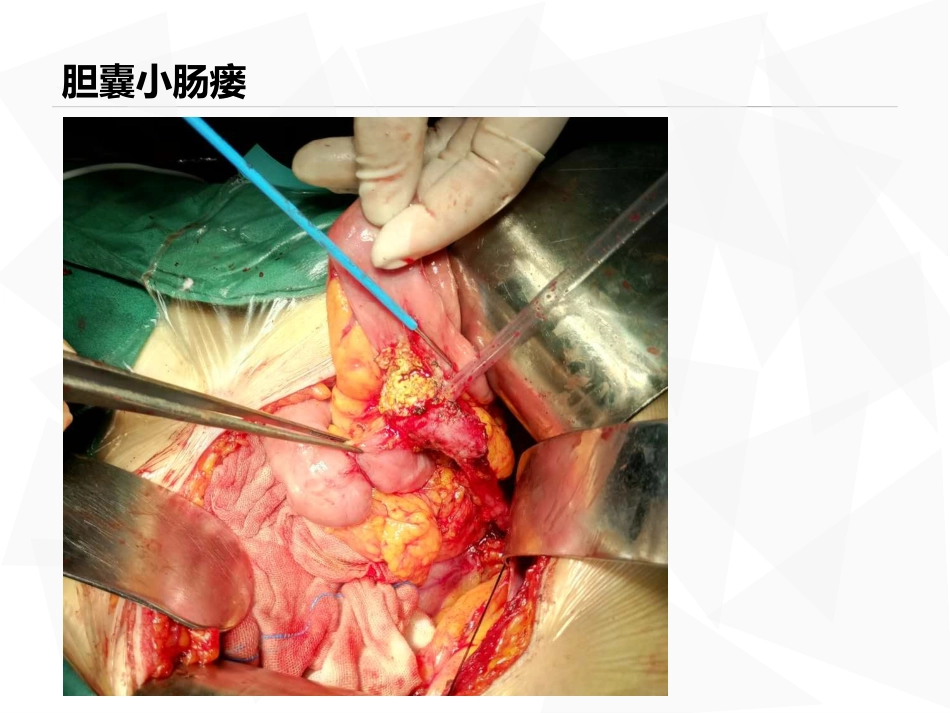 胆道镜课件_第6页