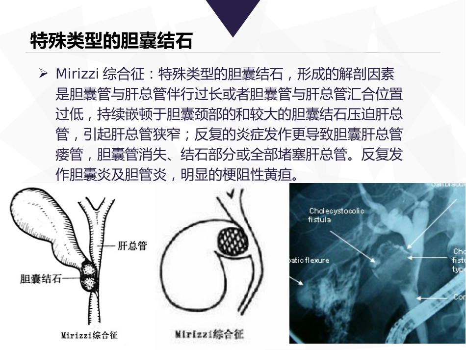 胆道镜课件_第7页