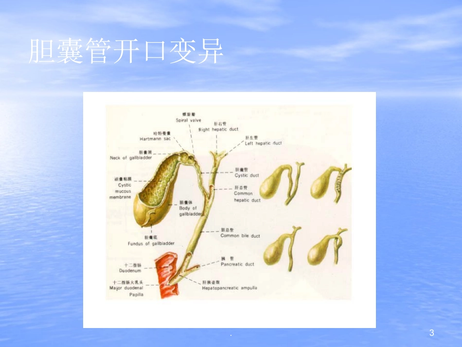 胆结石PPT幻灯片_第3页