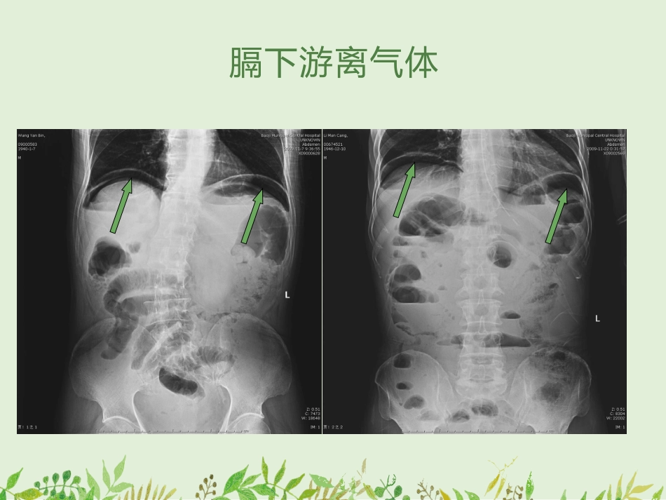 如何观察腹部X线平片-——腹部X线平片常见病的诊断_第15页