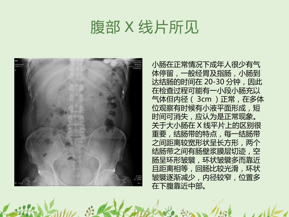 如何观察腹部X线平片-——腹部X线平片常见病的诊断_第4页