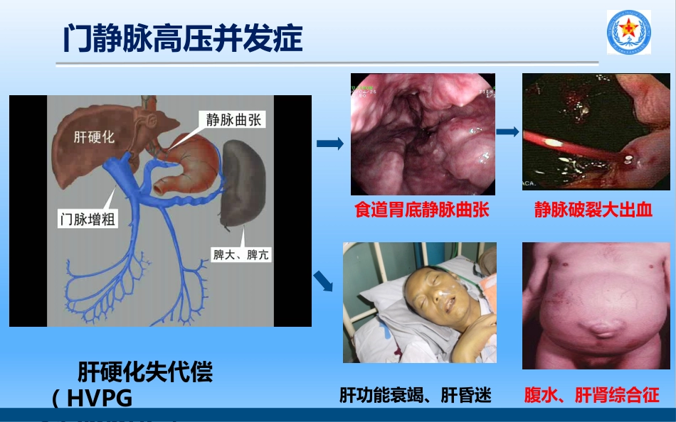 TIPS治疗肝硬化门脉高压_第2页