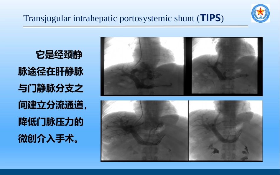 TIPS治疗肝硬化门脉高压_第4页