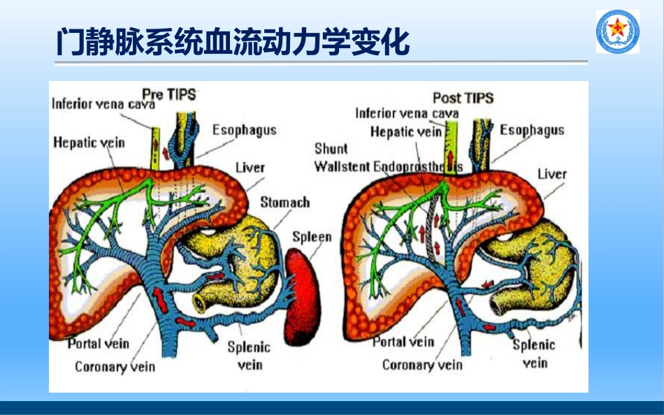 TIPS治疗肝硬化门脉高压_第5页
