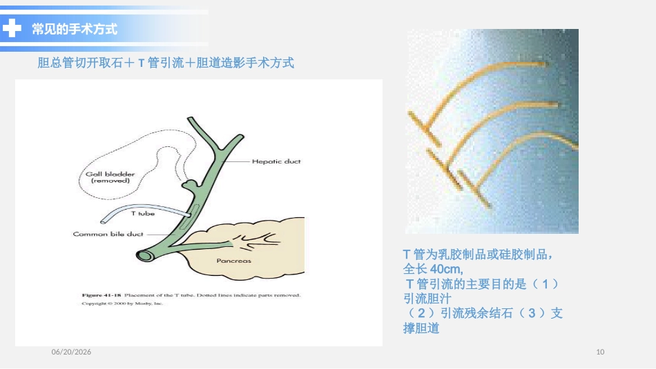 胆总管结石PPT参考课件_第10页